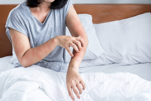 Bed Bug Bites